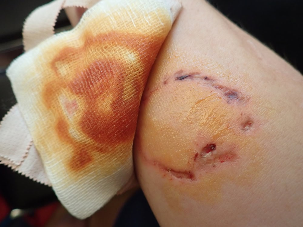 What to Do Immediately After a Dog Bite Attack - Kaushal Law
